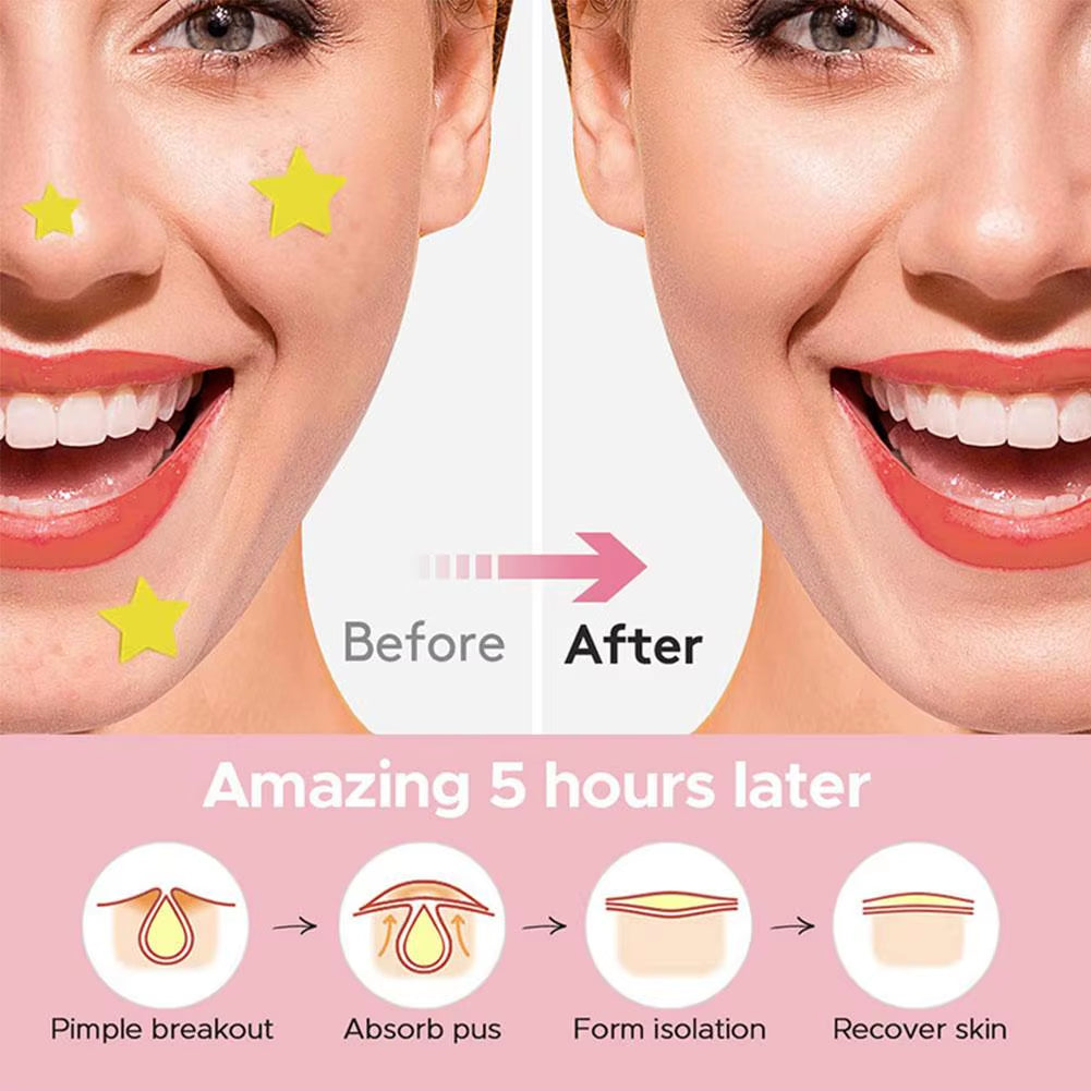 600 Patches Acne Patch Pimple Patch Sticker Waterproof Acne Treatment Pimple Remover Spot Facial Mask Skincare Hidden Pimple