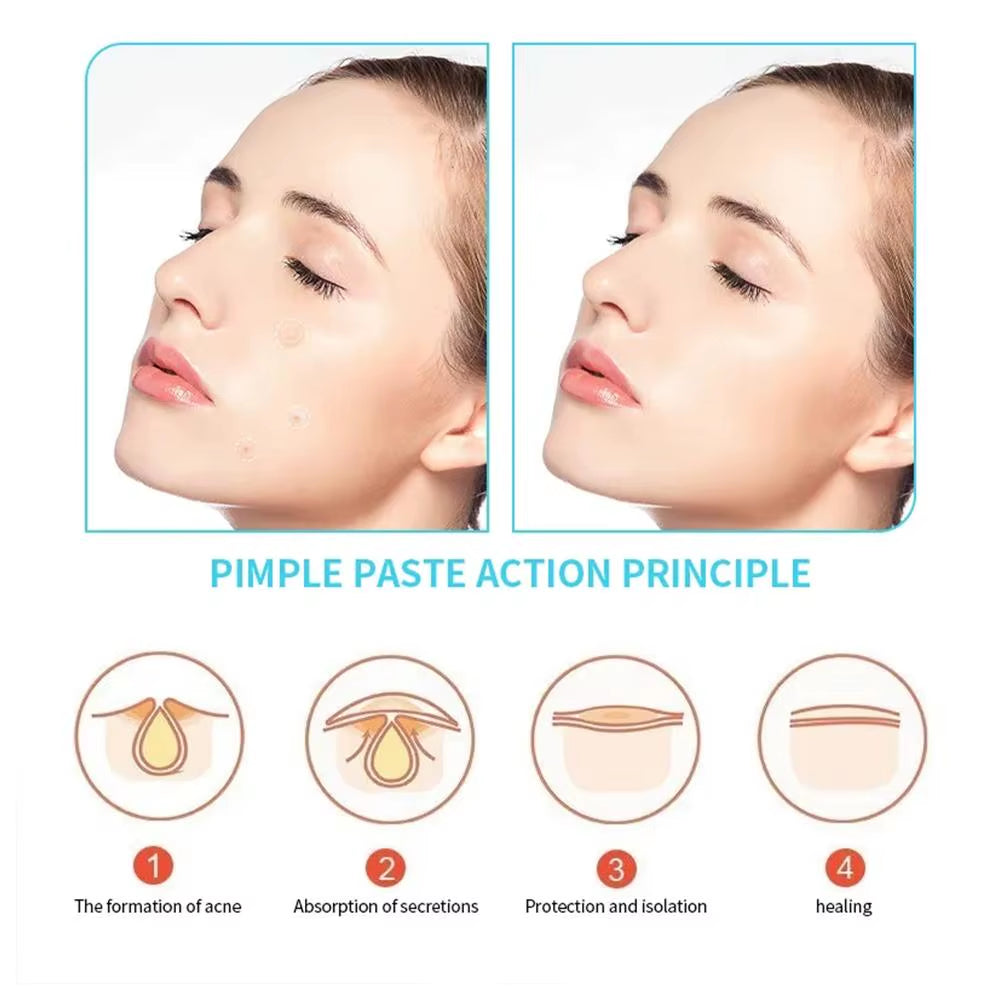 Acne Pimple Patch Stickers Waterproof Acne Treatment Tool Pimple Skin 30 Mask Blemish Spot Facial Care Remover Patches/Bag